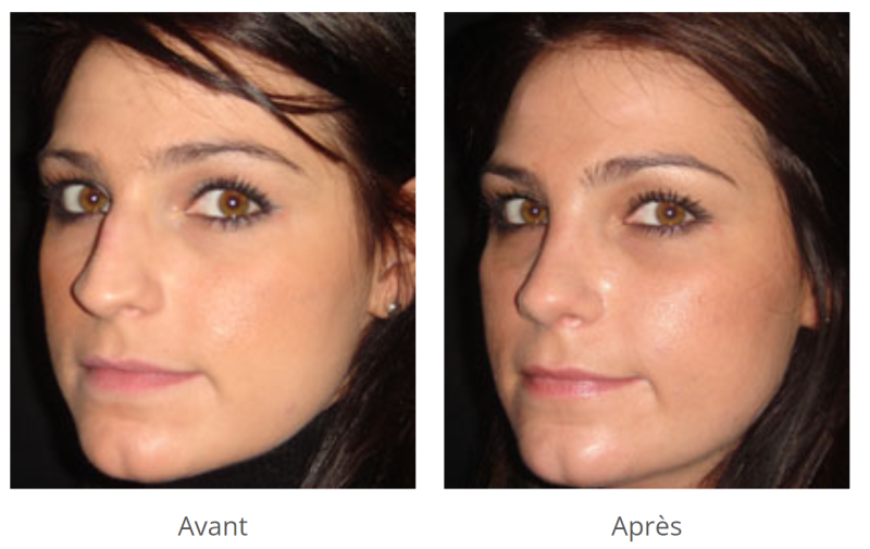 photo avant après CHIRURGIE DU NEZ (RHINOPLASTIE) à marseille et la ciotat