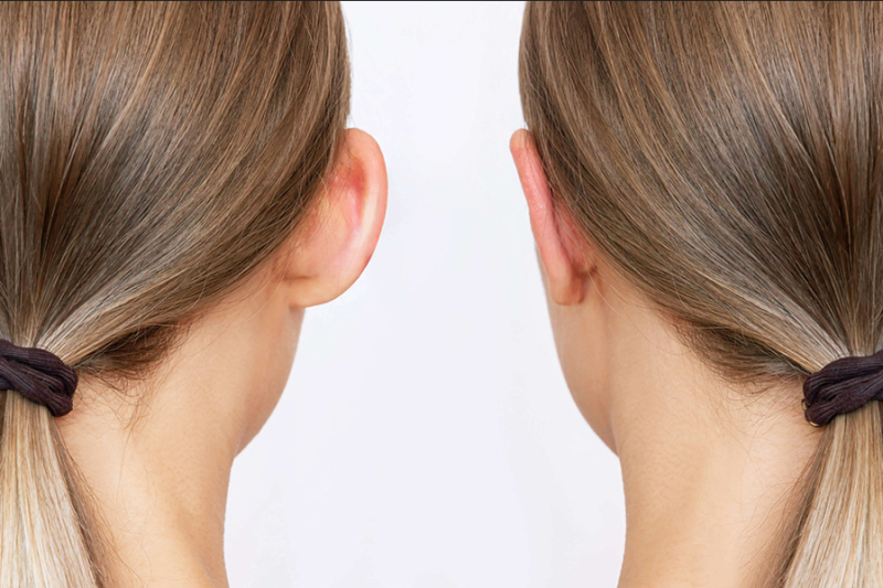 CHIRURGIE DES OREILLES DECOLLÉES OU OTOPLASTIE à Marseille et la Ciotat