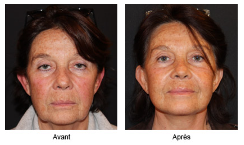 LES DIFFERENTS LIFTINGS DU VISAGE