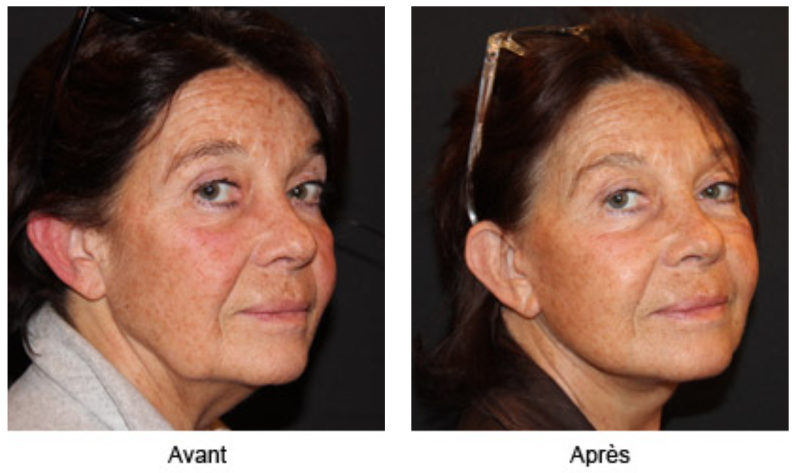 LES DIFFERENTS LIFTINGS DU VISAGE