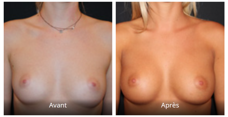 AUGMENTATION MAMMAIRE PAR PROTHESES OU IMPLANTS MAMMAIRES A MARSEILLE