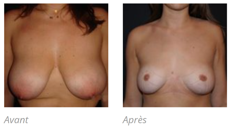 REDUCTION MAMMAIRE POUR HYPERTROPHIE A MARSEILLE