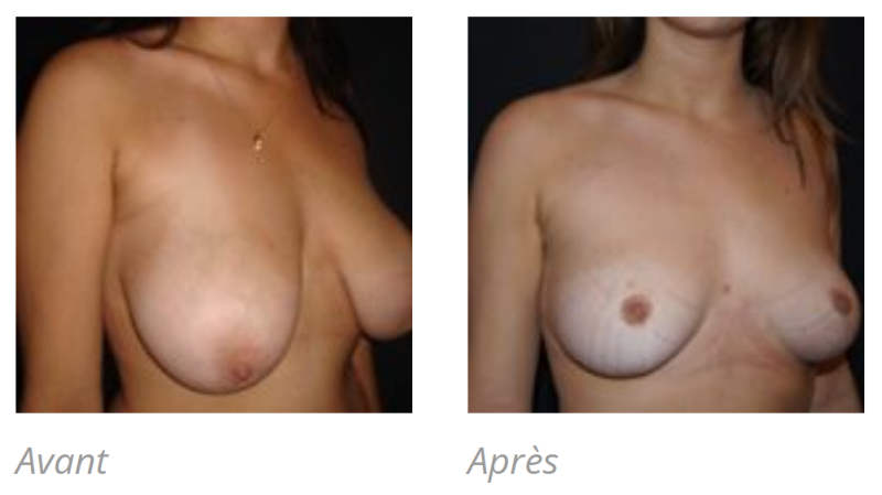 REDUCTION MAMMAIRE POUR HYPERTROPHIE A MARSEILLE