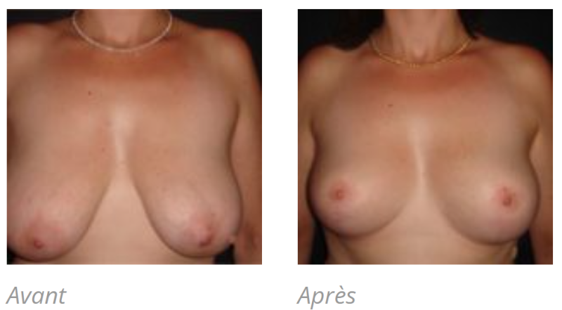 REDUCTION MAMMAIRE POUR HYPERTROPHIE A MARSEILLE