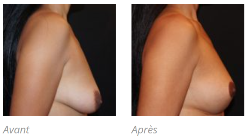 PTOSE MAMMAIRE A MARSEILLE