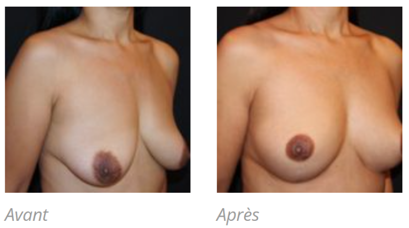 PTOSE MAMMAIRE A MARSEILLE