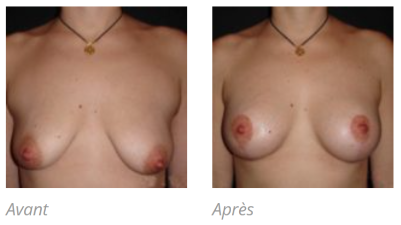 PTOSE MAMMAIRE A MARSEILLE