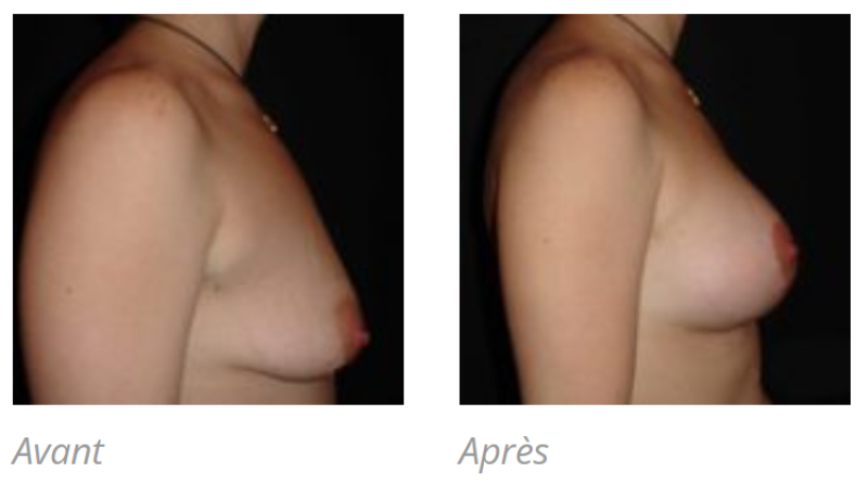 PTOSE MAMMAIRE A MARSEILLE