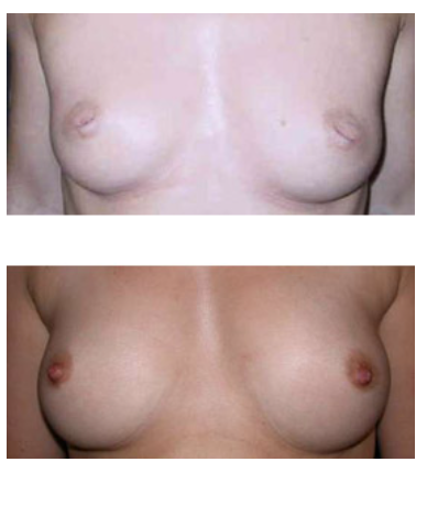 CHIRURGIE DE LA PLAQUE AREOLO MAMELONAIRE (P A M)