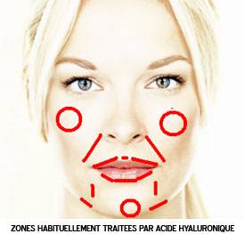 INJECTIONS DE PRODUITS DE COMBLEMENT (ACIDE HYALURONIQUE)