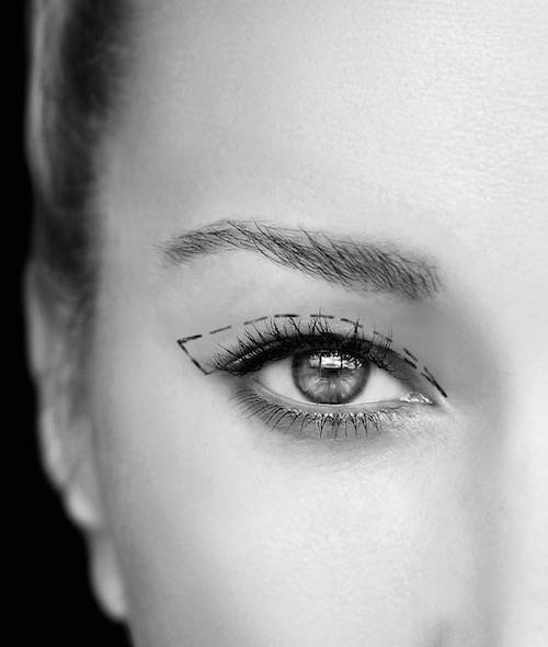 BLEPHAROPLASTIES