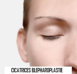 Quelle chirurgie du regard choisir ?