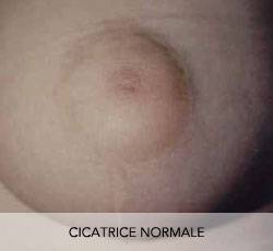 LES DIFFERENTES CICATRICES