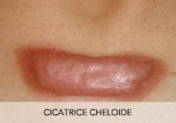 LES DIFFERENTES CICATRICES