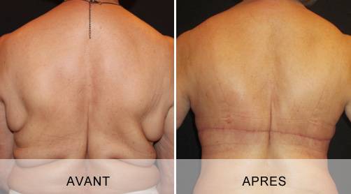 BODYLIFT SUPERIEUR ET INFERIEUR