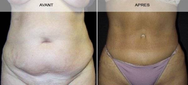 CHIRURGIE DE L’ABDOMEN (LIPECTOMIE ABDOMINALE) à Marseille et la Ciotat