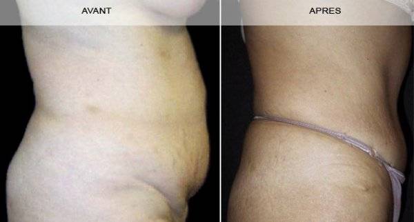 CHIRURGIE DE L’ABDOMEN (LIPECTOMIE ABDOMINALE) à Marseille et la Ciotat