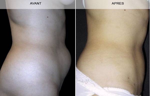 CHIRURGIE DE L’ABDOMEN (LIPECTOMIE ABDOMINALE) à Marseille et la Ciotat