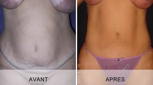 CHIRURGIE DE L’ABDOMEN (LIPECTOMIE ABDOMINALE) à Marseille et la Ciotat