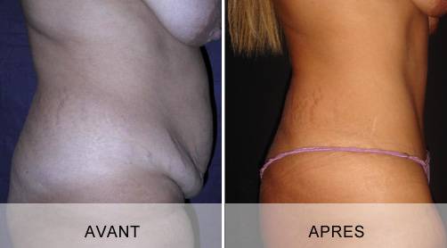 CHIRURGIE DE L’ABDOMEN (LIPECTOMIE ABDOMINALE) à Marseille et la Ciotat