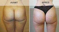 LIPOSUCCION DE LA SILHOUETTE