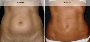 LIPOSUCCION DE LA SILHOUETTE