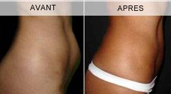 LIPOSUCCION DE LA SILHOUETTE