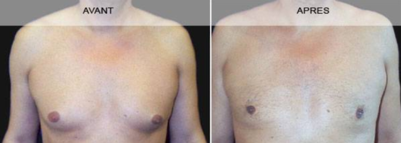 GYNECOMASTIE